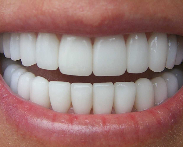 Faccette estetiche dentali Bari - Dentista Dr. Deodato