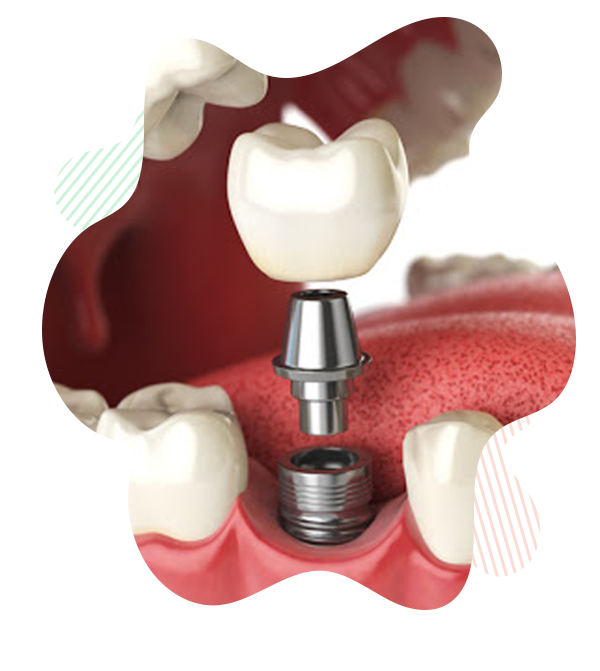 Implantologia dentale